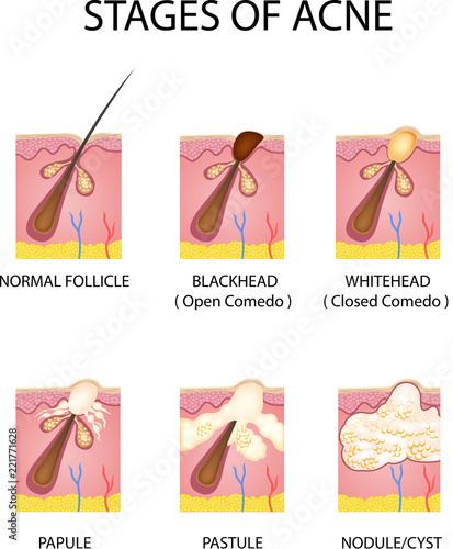 Stages of acne formation in the human skin