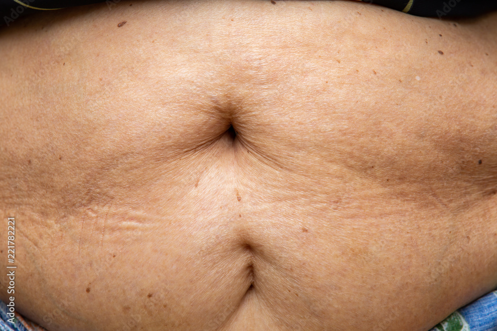 Senior women body fat belly front view, Sterilization scar, Black moles, Unhealthy concept Senior women body fat belly front view, Sterilization scar, Black moles, Unhealthy concept