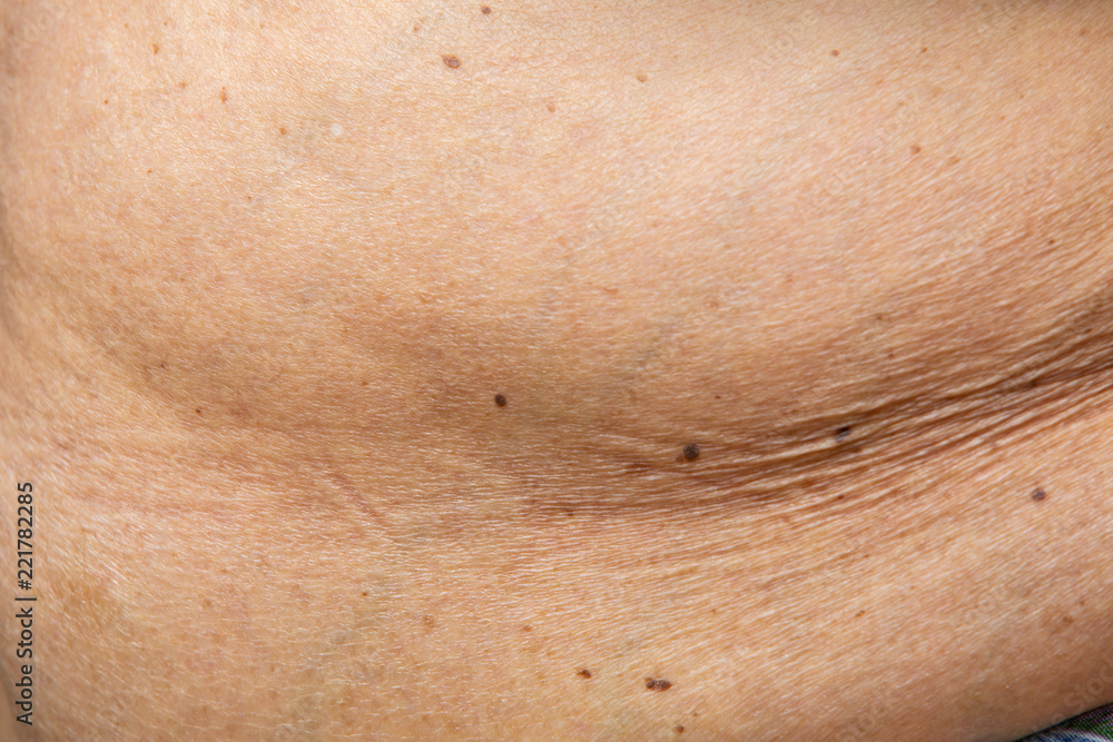 Senior women body fat belly front view, Black moles, Unhealthy  concept