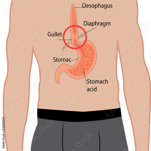 Gastroesophageal reflux desease. Gerd stomach in a human body vector illustration