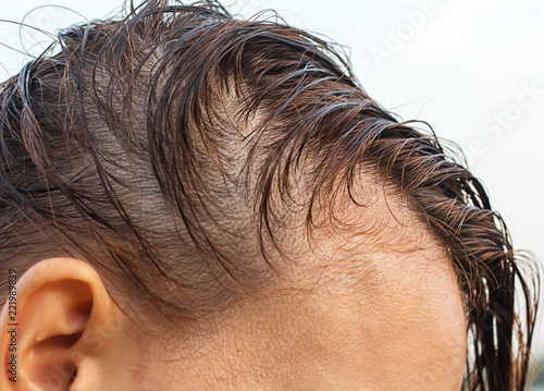 hair loss woman photo