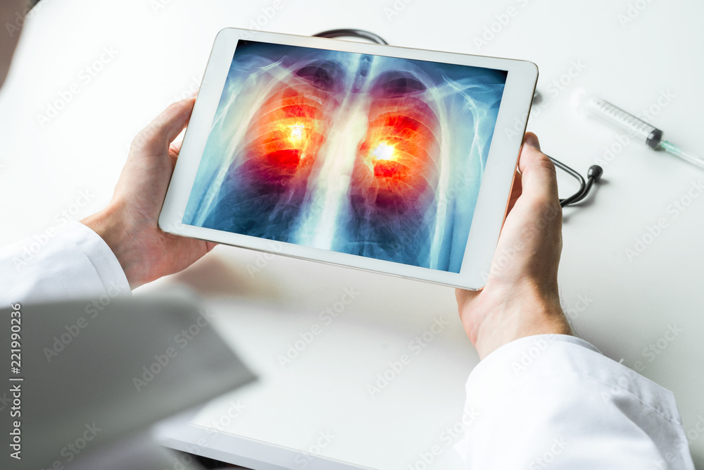 Ταπετσαρία Doctor watching a xray of lung cancer on digital tablet
