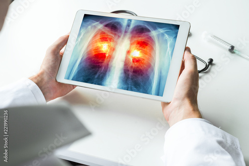 Doctor watching a xray of lung cancer on digital tablet. Radiology concept