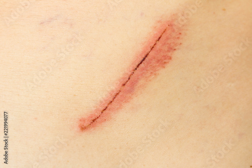 A wound on the human body. Scar close-up. A deep cut on the body