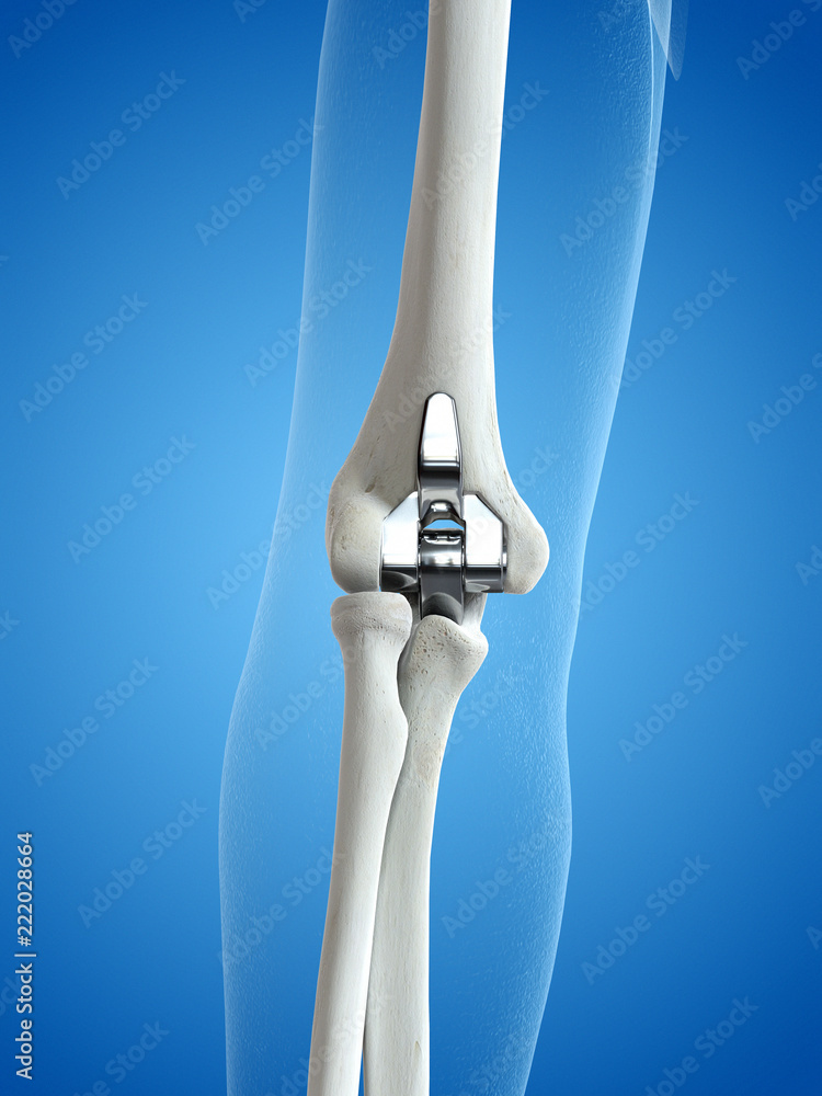3d rendered medically accurate illustration of an elbow replacement