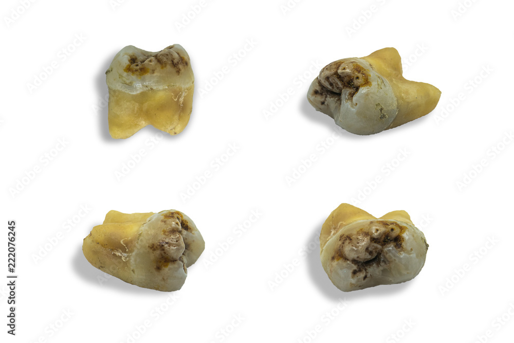 tooth with dental caries on white background tooth with dental caries on white background