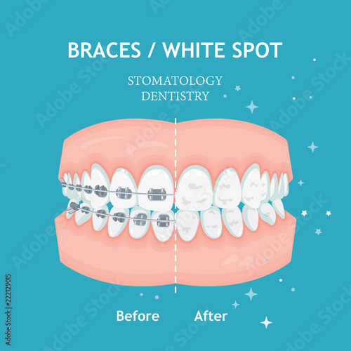 Braces concept. White spots. Stomatology dentistry vector