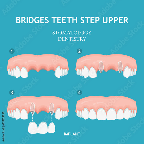 Dental concept. Dentistry and stomatology poster. Bridges teeth step upper.