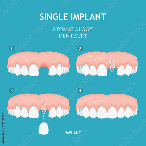 Dental concept. Dentistry and stomatology poster. Single implant.