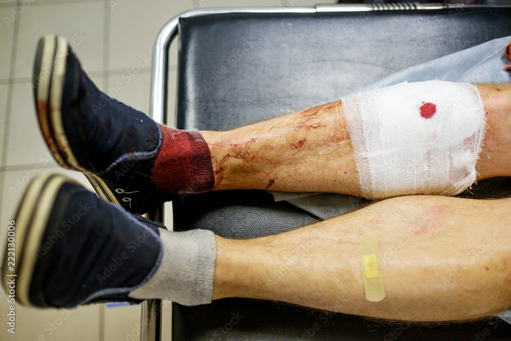 Traumatized by the bloody human foot with a temporary bandage on a hospital  bed in a building emergency room waiting for the doctor, after a car  accident. Close-up. Photos | Adobe Stock