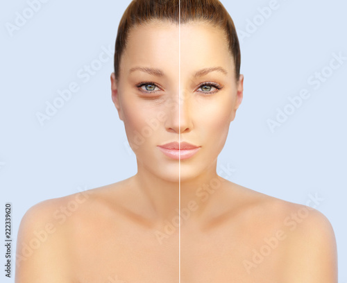 Lower eyelid blepharoplasty.Upper blepharoplasty.Before and after cosmetic procedures