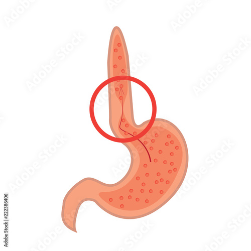 Gastroesophageal reflux desease. Gerd stomach vector illustration