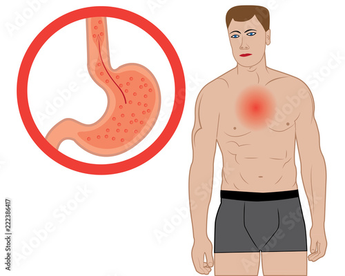 Gastroesophageal reflux desease. Gerd stomach in a human body vector illustration