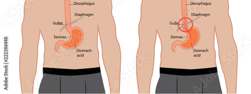 Gastroesophageal reflux desease. Gerd stomach in a human body vector illustration