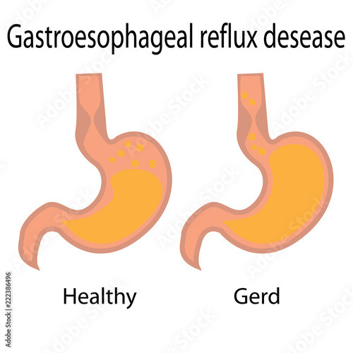 Gastroesophageal reflux desease. Healthy and gerd stomach vector illustration