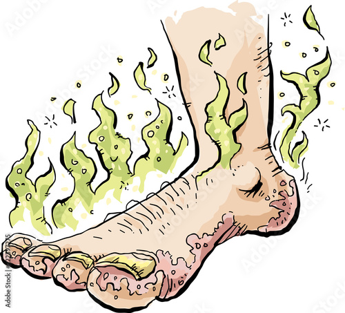 A stinky cartoon foot infected with toenail fungus and Athlete's Foot.
