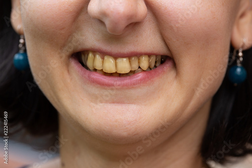 Close up of mouth with yellow teeth