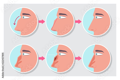Rhinoplasty before and after the procedure infographics. Nose plastic surgery vector cartoon flat concept medical illustration.