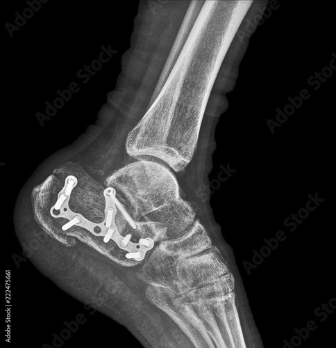 X-ray of a calcaneus fracture osteosynthesis photo