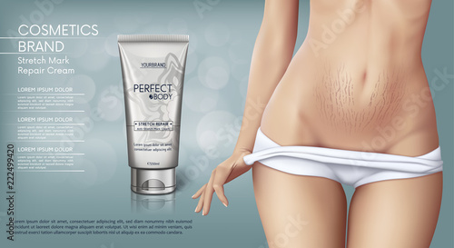 Web banner design of Stretch mark removal cream. Concept vector illustration of skin care and with woman with stretch marks on belly photo