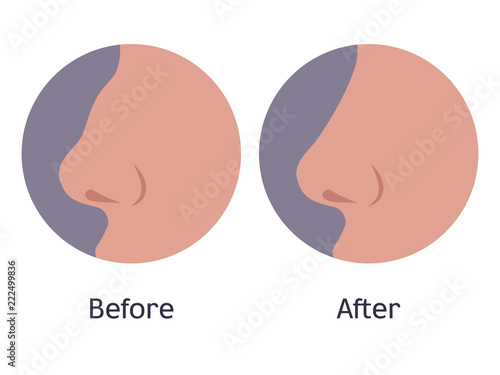 Nose before and after plastic surgery
