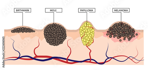The difference between a birthmark, mole, papilloma and melanoma. Infographics