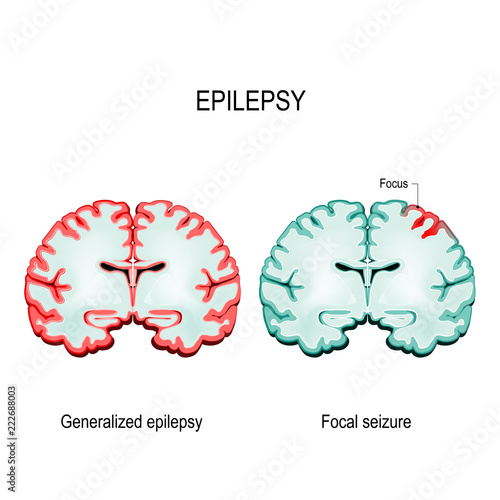  primary generalized epilepsy and focal seizures