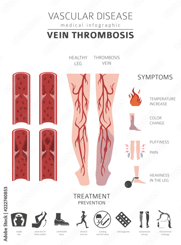 Vascular diseases. Vein thrombosis symptoms, treatment icon set. Medical infographic design Vascular diseases. Vein thrombosis symptoms, treatment icon set. Medical infographic design