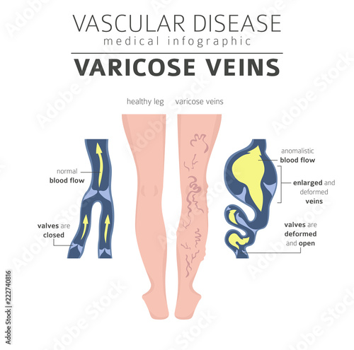 Vascular diseases. Varicose veins symptoms, treatment icon set. Medical infographic design