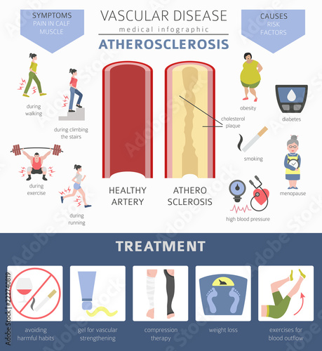 Vascular diseases. Atherosclerosis symptoms, treatment icon set. Medical infographic design