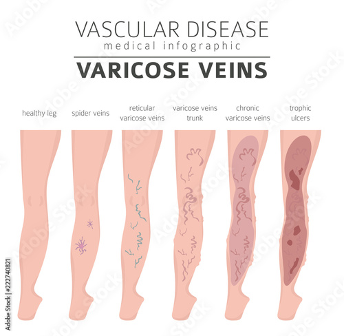 Vascular diseases. Varicose veins symptoms, treatment icon set. Medical infographic design