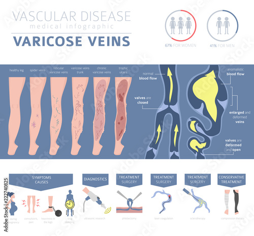 Vascular diseases. Varicose veins symptoms, treatment icon set. Medical infographic design