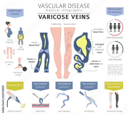 Vascular diseases. Varicose veins symptoms, treatment icon set. Medical infographic design