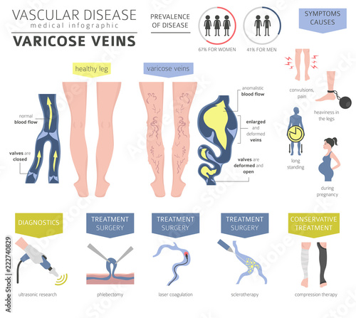 Vascular diseases. Varicose veins symptoms, treatment icon set. Medical infographic design