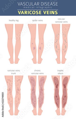 Vascular diseases. Varicose veins symptoms, treatment icon set. Medical infographic design