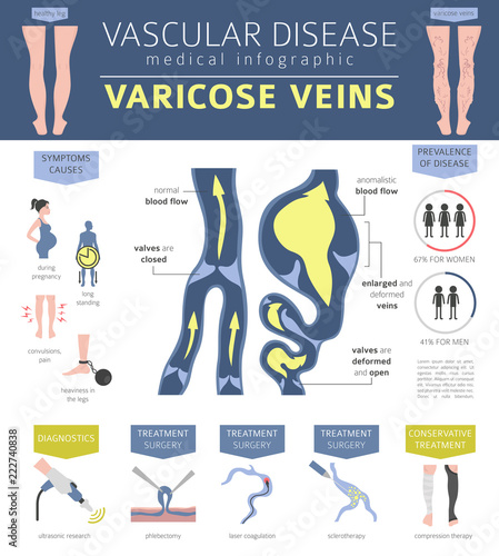 Vascular diseases. Varicose veins symptoms, treatment icon set. Medical infographic design