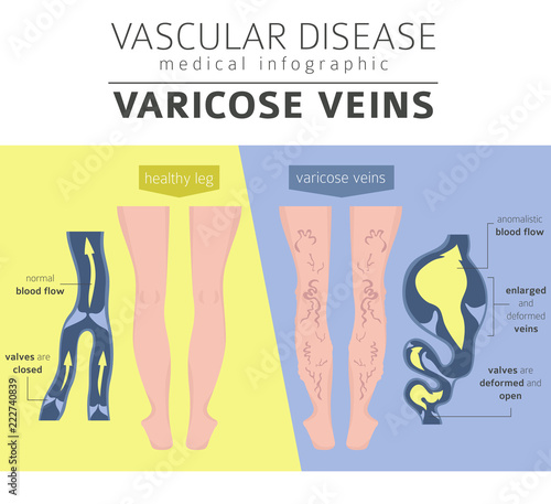 Vascular diseases. Varicose veins symptoms, treatment icon set. Medical infographic design