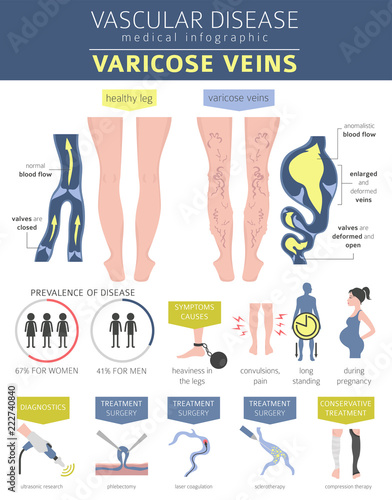 Vascular diseases. Varicose veins symptoms, treatment icon set. Medical infographic design