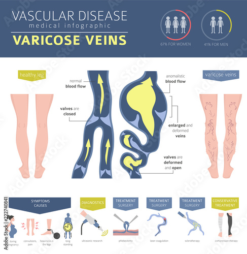 Vascular diseases. Varicose veins symptoms, treatment icon set. Medical infographic design