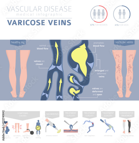 Vascular diseases. Varicose veins symptoms, treatment icon set. Medical infographic design