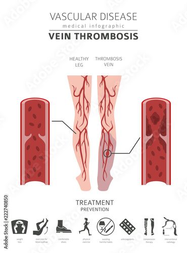 Vascular diseases. Vein thrombosis symptoms, treatment icon set. Medical infographic design