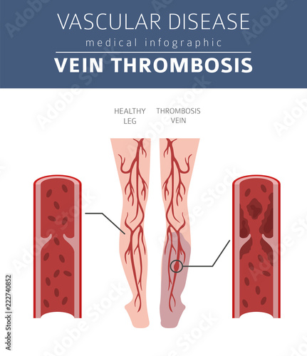 Vascular diseases. Vein thrombosis symptoms, treatment icon set. Medical infographic design