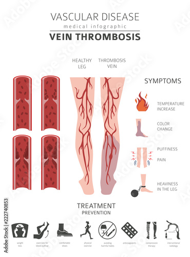 Vascular diseases. Vein thrombosis symptoms, treatment icon set. Medical infographic design