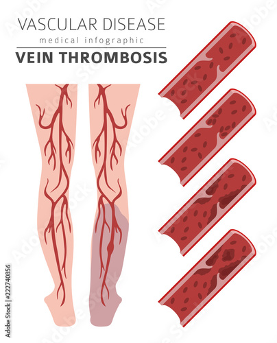 Vascular diseases. Vein thrombosis symptoms, treatment icon set. Medical infographic design