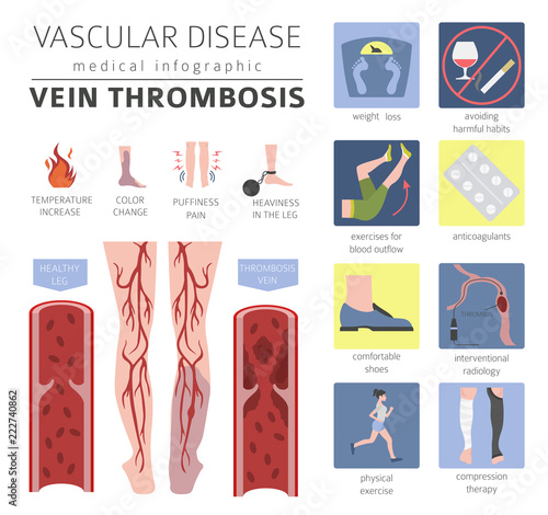 Vascular diseases. Vein thrombosis symptoms, treatment icon set. Medical infographic design