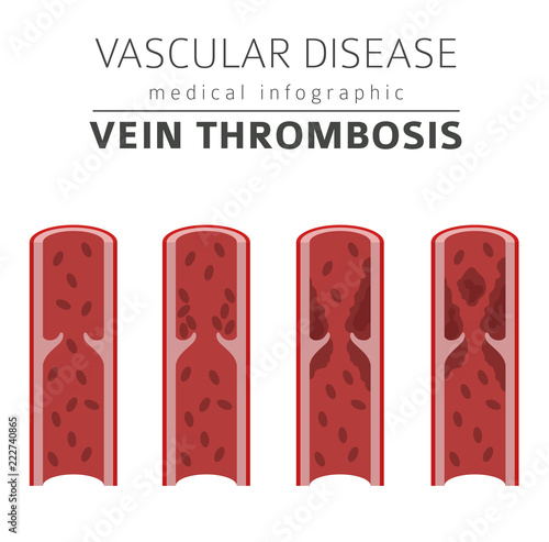 Vascular diseases. Vein thrombosis symptoms, treatment icon set. Medical infographic design