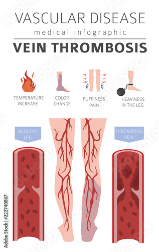 Vascular diseases. Vein thrombosis symptoms, treatment icon set. Medical infographic design