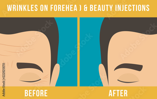 Man's anti-aging skin care and men's cosmetics. Different types of facial wrinkles. Man before and after Botox injection. Anti-aging procedure. Vector