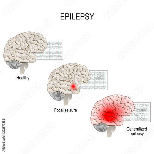 Epilepsy. EEG of healthy brain and epileptic seizure.