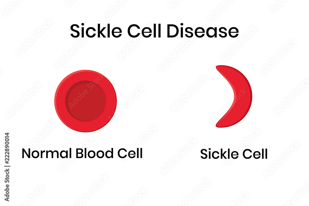 Sickle cell anemia. Normal erythrocyte against distorted sickle cell.
